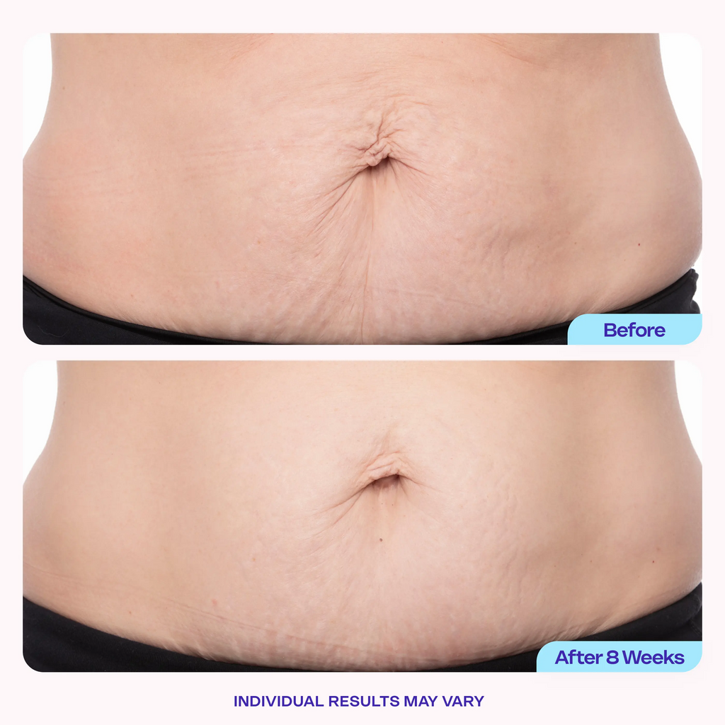 GOPURE Tighten & Smooth Belly Firming Cream | 6% MicroTight4 Complex | Stretch Marks & Loose Skin | 125ml
