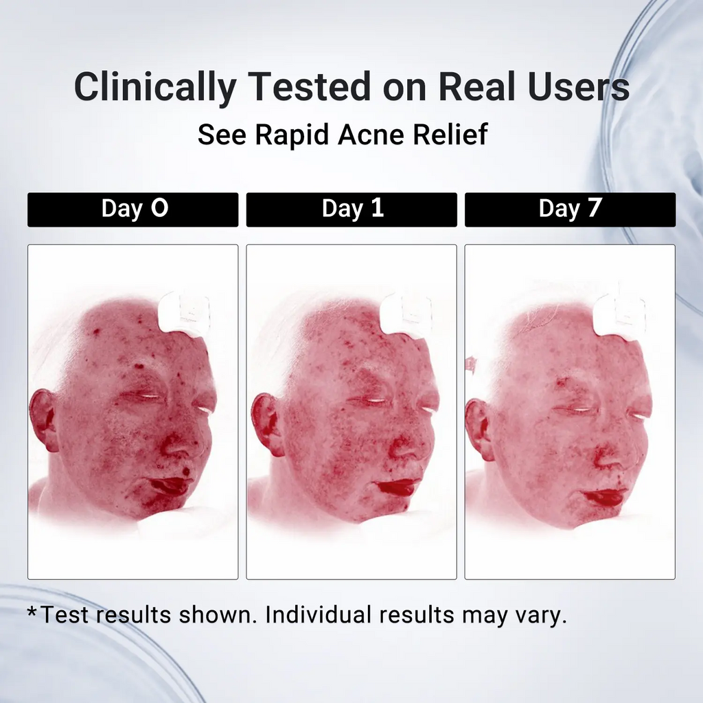 Dr.Leo Drying Lotion | Salicylic Acid & Niacinamide Blemish Spot Treatment for Acne-Prone Skin